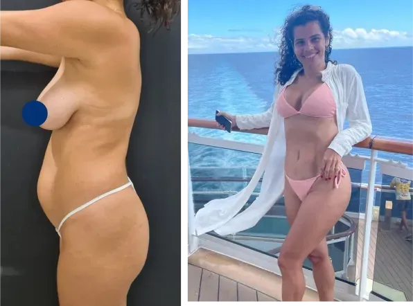 Body contouring result with Dr. Alexandre Charão in Rio de Janeiro