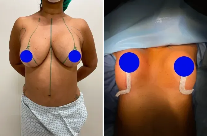 Before and after plastic surgery in Rio de Janeiro — Dr. Alexandre Charão
